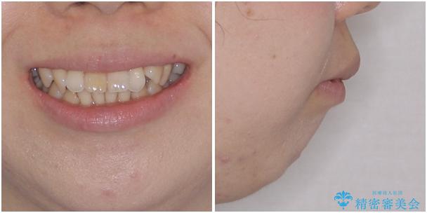 抜歯矯正で閉じにくかった口を閉じやすく改善の治療前（顔貌）