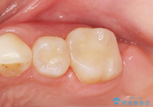 フロスを通すと臭い　歯と歯の間の虫歯　セラミックインレー　30代女性の治療後