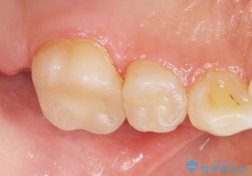フロスを通すと臭い　歯と歯の間の虫歯　セラミックインレー　30代女性の治療後