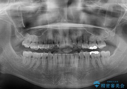 顕著な八重歯をインビザラインで治せるところまで改善の治療後