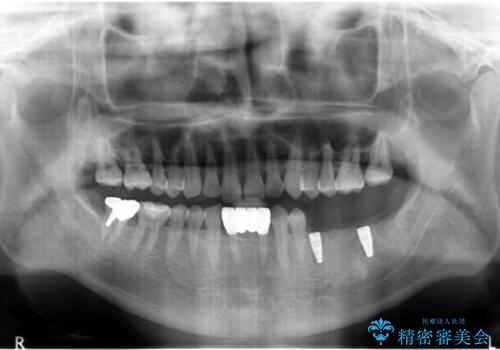 奥歯のインプラント　大人になって残っていた乳歯がダメになったの治療中