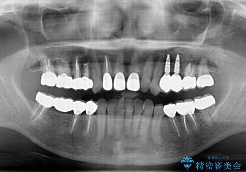 [ セラミック・インプラント全顎治療 ]  長年悩まされている歯の治療にケリをつけたいの治療後