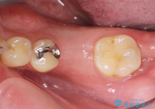 銀歯下の虫歯再発　インプラントによる機能回復の治療中