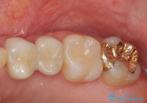 放置された虫歯　小矯正+歯周外科による保存処置の治療後