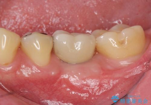 銀歯下の虫歯再発　インプラントによる機能回復の治療後