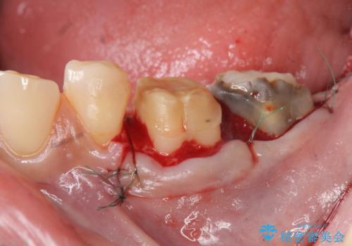 歯周外科で達成する、安定したクラウン周囲の歯肉環境の治療中