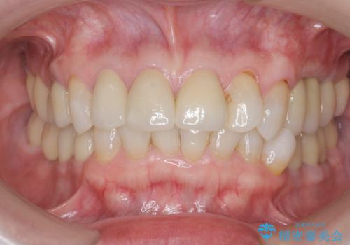 [ セラミック・インプラント全顎治療 ]  長年悩まされている歯の治療にケリをつけたいの症例 治療後